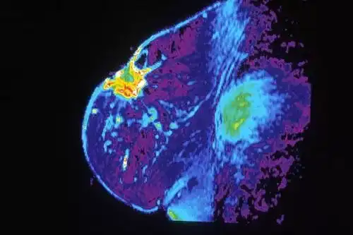 MRI of breast (national cancer institute)